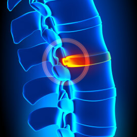 Spinal Cord Decompression Surgery | North Dallas | Spine Vue