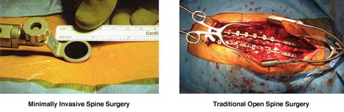 Images of Spine Surgery